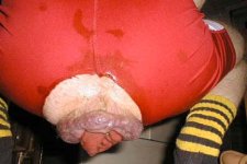 rectalprolapse.jpg