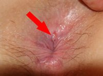 230px-Anal_fissure_2.jpg