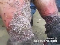 russia-homeless-man-ankles-necrotic-swarming-with-maggots.jpg